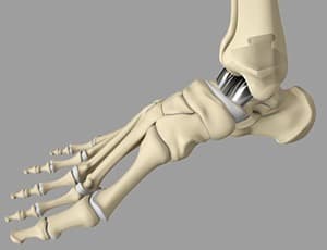 Ankle replacement